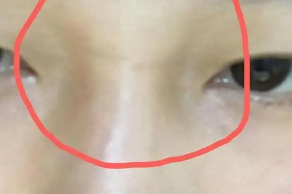 山根有横纹的女人面相:婚姻运势受阻碍,健康状况受威胁_探秘志