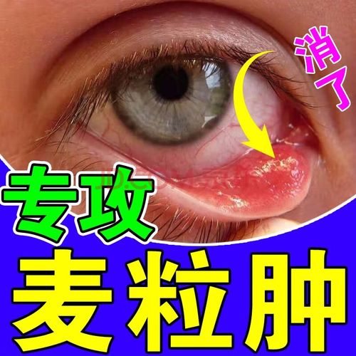 眼贴霰粒肿睑板腺堵塞视物模糊沙眼灼烧感眼痛痒异物感眼睑炎红肿