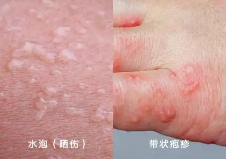 水泡和疱疹的区别图片对比大全