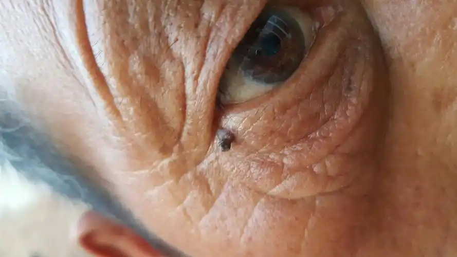 家里老人眼睛上长的,越长越大.