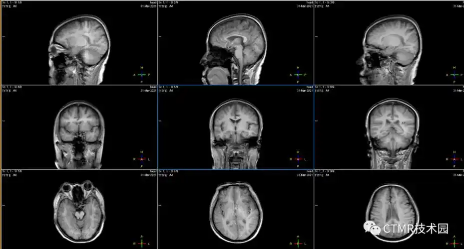 手把手教你基础颅脑mr平扫及后处理
