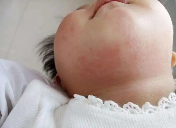 偏方不靠谱医院又治不好宝宝湿疹这样护理好得快