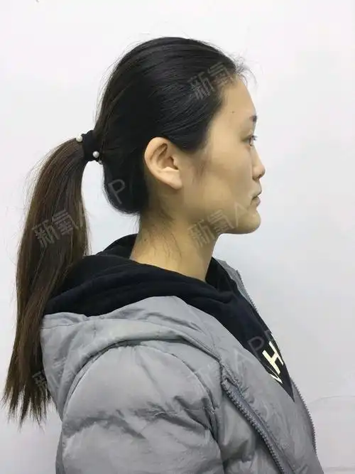 大家看照片就知道我是鼻子又瘪又塌,特别是侧面真一点_圈子-新氧美容