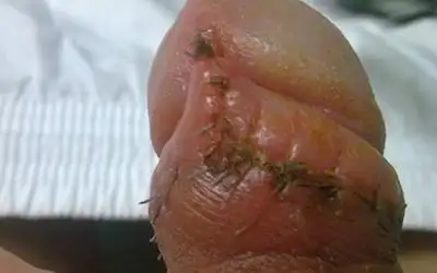 包皮过长,性冷淡,手术后的事你懂多少!