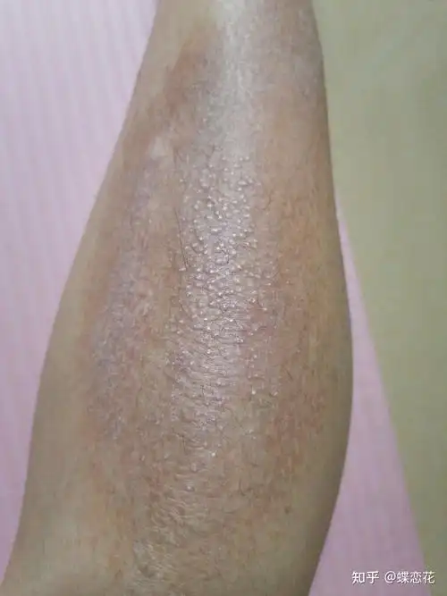 皮肤淀粉样变的朋友看过来皮肤淀粉样变并不是医生说的那样无药可医