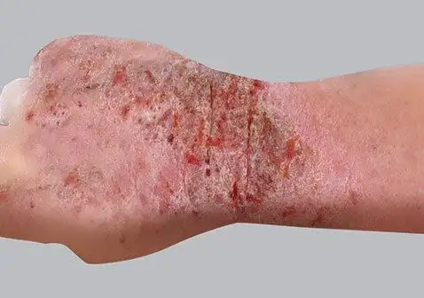 大人湿疹图片初期症状图片大全_银屑病求医网