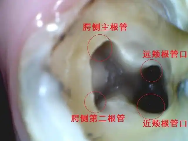 根管病例展示 - 宣城口腔医院|宣城牙科医院|宣城牙齿矫正|宣城牙齿
