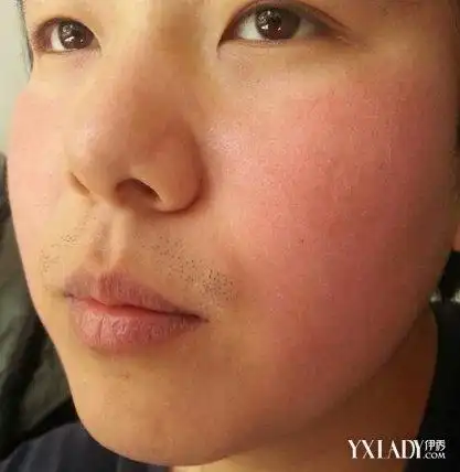 面部发烫发红怎么办3个步骤有效预防红脸蛋