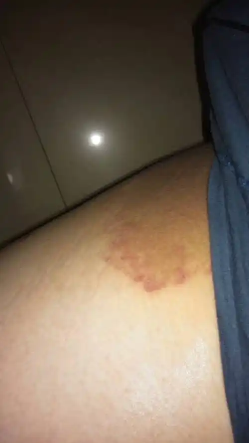 身上患有牛皮癣 大腿内侧出现黑斑 两年了渐渐扩大 有异味瘙痒 请问是