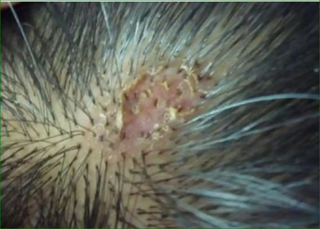 你的头上是不是在长癣?头皮屑"满天飞"吗?头上发红,发痒吗?