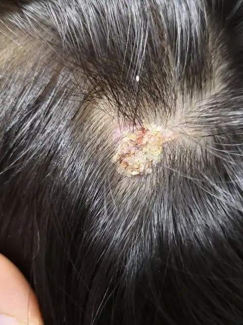 孩子头上长啦一块指甲大的东西 不知道是猴子,还是扁平疣,寻常痣.