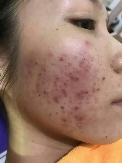 痘,敏,斑……问题性皮肤治疗调理!