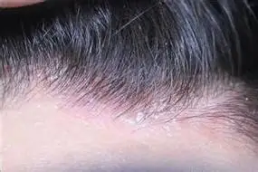 头皮痒有小疙瘩用什么洗发水