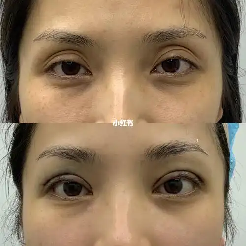 通过眶隔释放手术重排眼窝内部脂肪填充眼窝凹陷