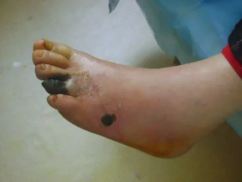 脚趾干性坏疽在我院不截肢治好2,干性坏疽,干性坏疽是由于肢端末梢