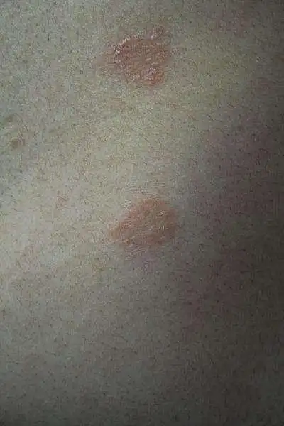 白癣图片早期症状图片 皮肤癌早期症状图片-图片大观-奇异网