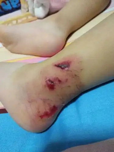 出了一点小意外,坐爸爸自行车把脚弄受伤了.