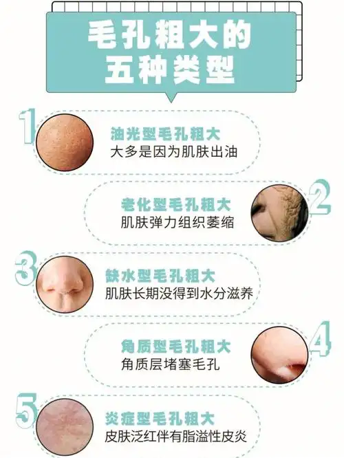 毛孔粗大的5大类型你了解吗