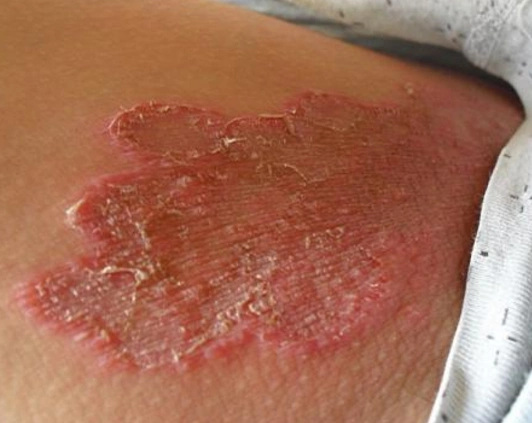 体癣图片_体癣症状表现图片大全_有来医生