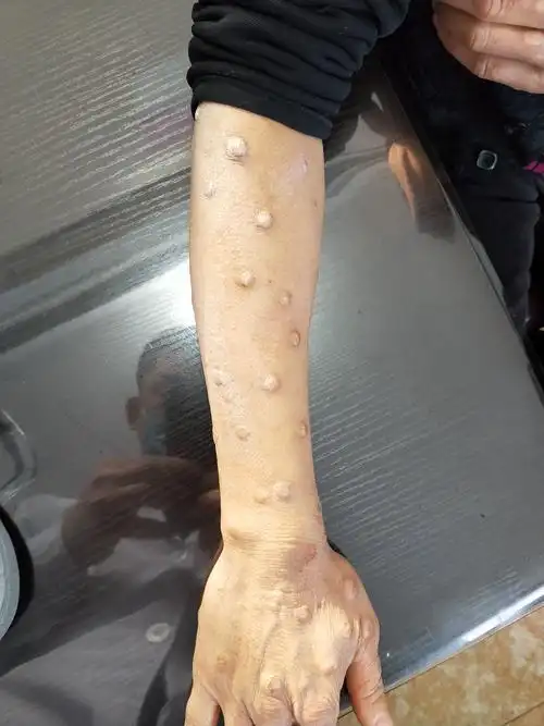 典型的皮肤病图片