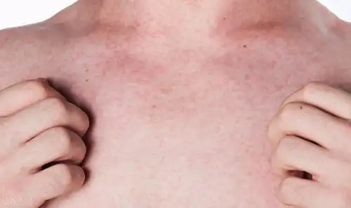 男子胸前长"小红点"查出肝癌?提醒:4个症状出现,早查肝ct