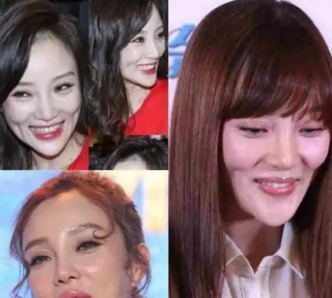 盘点女星整容后遗症四小花旦谁的脸最先垮