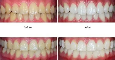 色素牙美白前后对比