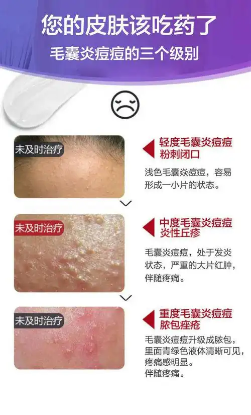 治毛囊炎马拉色菌胸前后背糠秕孢子菌毛囊炎膏薬草本萃取快速 桔色