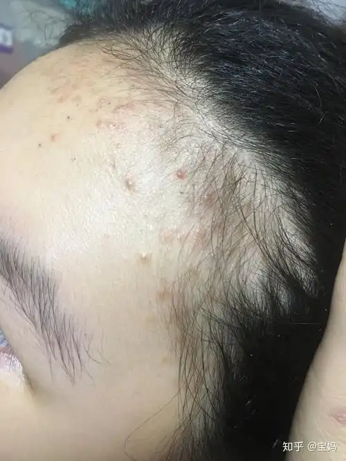 关于毛囊炎脂溢性皮炎痤疮的区别