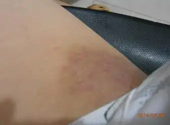 大腿内侧,这是怎么了,很痒