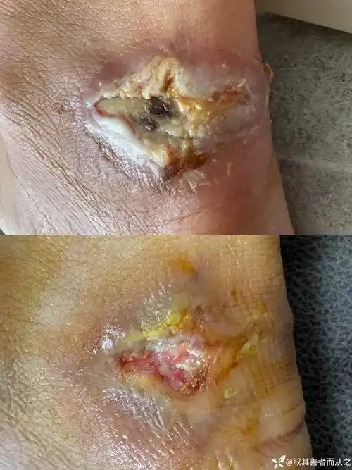 外伤皮肤坏死创面一例