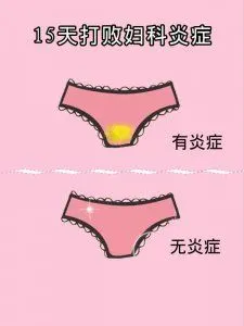 妇科炎症霉菌型阴道炎白带异常各种炎症