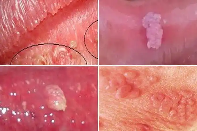 尖锐湿疣是什么病