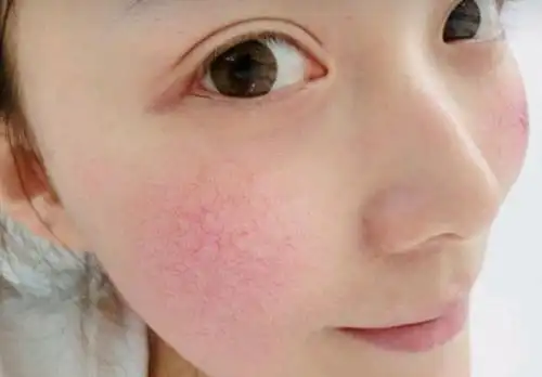 早上不能用洗面奶难怪脸干还蜕皮