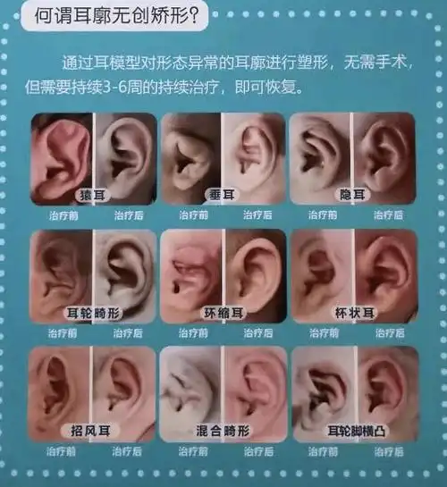 妇幼健康丨小耳畸形是父母的错吗