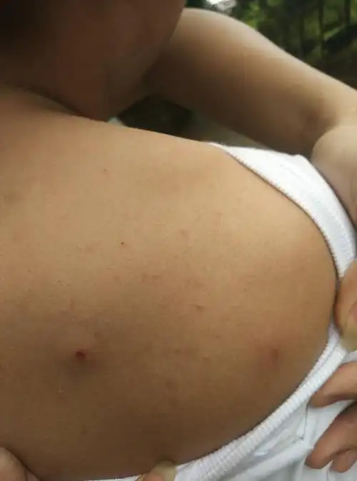 背上长了这样的包怎么回事啊