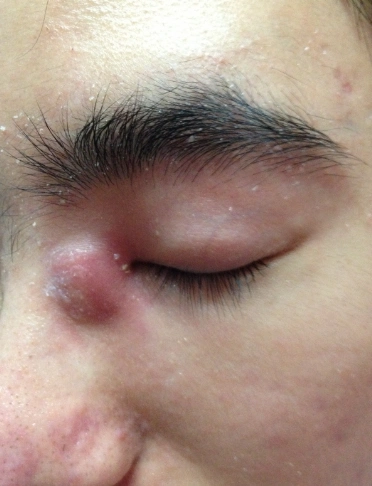 眼角长了个疙瘩图片7