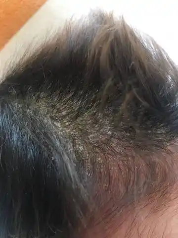 一个多月的宝宝头皮这是什么呀?头皮屑也不像 厚厚的一块