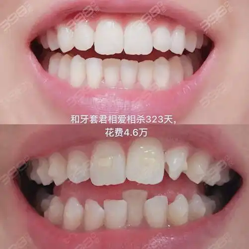 25岁以后还能牙齿正畸吗选隐形矫正好还是金属矫正好