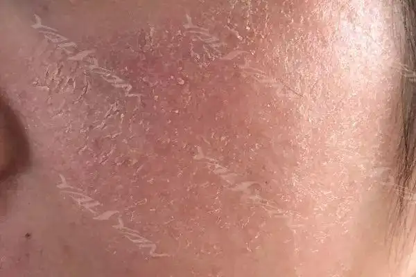 角质层受损并不是一朝一夕就能造成的,更多的还是与我们日常的护肤