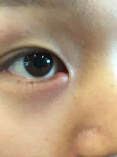 医生好请问右眼内眼角外沿肿了眼圈周围也有些疼眨眼不舒服