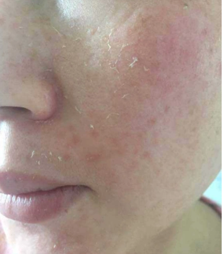 怎么判断自己角质层厚薄皮肤角质层薄可以通过哪些项目来进行改善