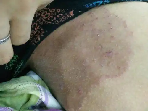 大腿内侧长得,这是什么啊,怎么办啊