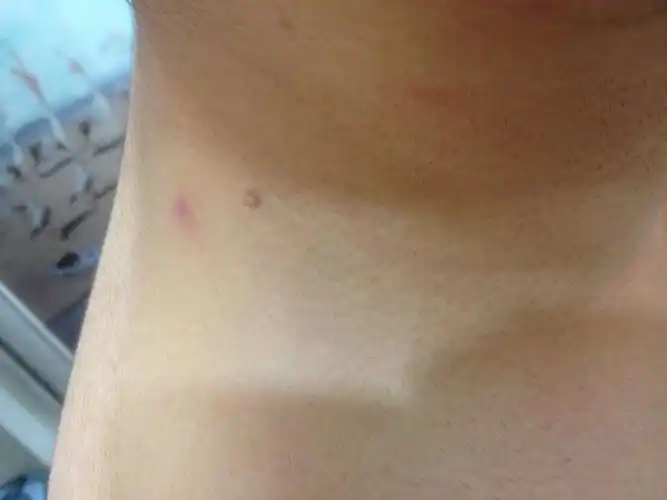 脖子上长了一个肉疙瘩,医生朋友帮我鉴定一下,我这疙瘩有2-3年了.