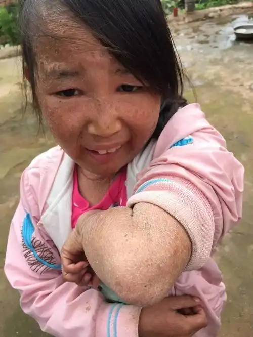 你所帮助过的"鱼鳞病"孩子现在怎么样了?《人鱼天使》