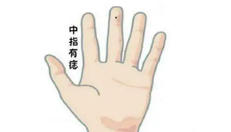 男人左手中指有痣图解左手有痣代表了什么