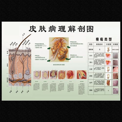 皮肤疾病常见图谱痤疮与色斑产生的原因医院皮肤科挂图宣传海报