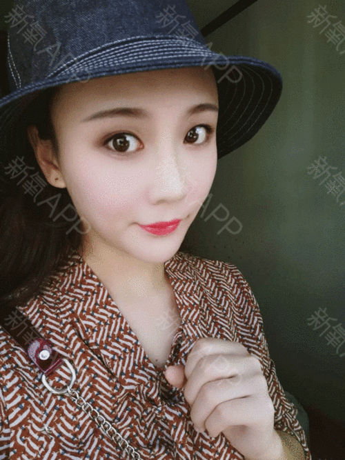 新自体脂肪全脸填充好不好_效果图_丽er自体脂肪全脸填充术后第15天