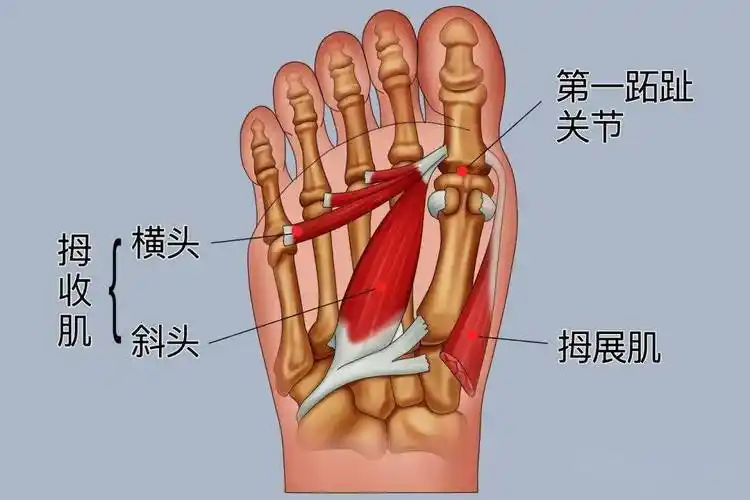 横弓和纵弓向下塌陷,牵拉患足的踇收肌和踇长伸肌致使踇趾向外侧移位