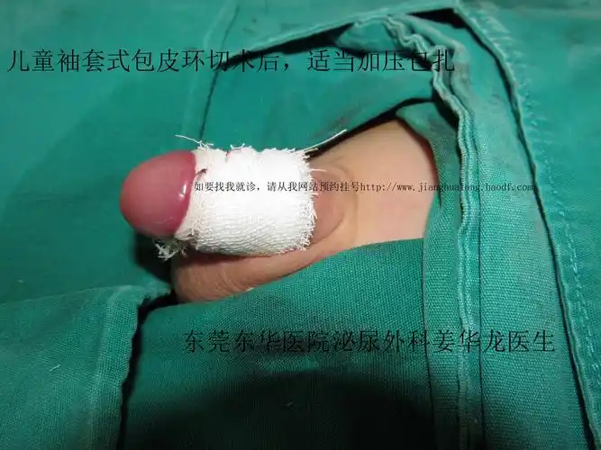 包皮手术取环后_包皮手术后多久可以同房_包皮淋巴管炎可以手术切除吗